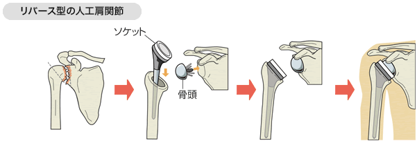 新技術のリバース型人工肩関節置換術（Reverse Shoulder Arthroplasty